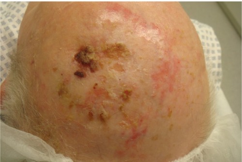 Figure 2 A 57-year-old patient with chronic actinic damage, multiple actinic keratoses and a T2 squamous cell carcinoma on the scalp. Field cancerization is an important differential diagnosis to erosive pustular dermatosis of the scalp.
