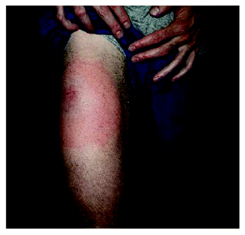 Figure 5. Skin reactions characterized by erythema, swelling and warmth occurred commonly at the immunization site, following sc/id injection of irradiated GM-CSF secreting K562 cells. These reactions were transient, lasting 1–5 d following vaccination.