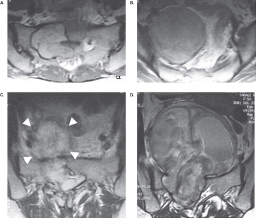 Figure 4. Axial image of T2-weighted MRI showing a big tumor extending from the spinal canal through the sacral body of S1 (A) to the presacral region (S2 level (B)) before surgery. The tumor was partially removed via a combination of the anterior and posterior approach. Axial image of T2-weighted MRI immediately after the surgery (C) showing a postoperative hematoma in the remaining tumor capsule (white arrow-head). Seven years after the surgery, the remaining tumor grew (D), and complete removal of the tumor with S1 root sacrifice was performed.