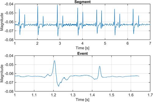 Figure 6 Time-domain representation of the acquired vascular sounds. A 7 second segment (top) of each measurement was used for the segment-based stability analysis and one full heart cycle representing one event (bottom) for the event-based analysis.