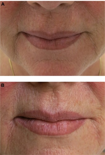 Figure 5 A 60-year-old woman with flattening of Cupid’s bow and downward turn of the commissures.