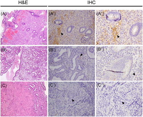 Figure 4. Vasn immunoreactivity in the normal proliferative-secretory phase endometrial tissue and normal myometrium. (A-B-C) Histological images stained with hematoxylin and eosin (H&E) of human uterine tissues. Vasn expression was evident in the stromal cells of proliferative endometrium (A’-A’’, arrow). Vasn expression was extremely weak in the stroma of secretory endometrium (B’-B’’, arrow). Vasn expression was absent in the myometrium (C’-C’’). Scale bar = 200 µm.