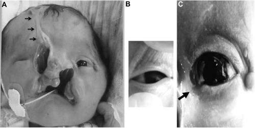 Figure 1 Facial images of the female infant with optic-nerve hypoplasia and anterior segment abnormality associated with facial cleft.