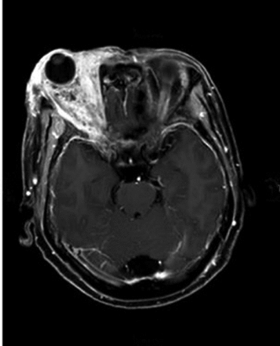 Figure 6. MRI image of the tumor prior to anlotinib hydrochloride. The tumor was located in the right orbit, with massive extension into the right maxillary sinus, ethmoid sinus, frontal sinus, sphenoid.