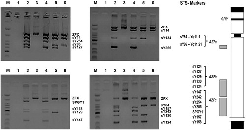 Figure 1. Multiplex PCR analysis with STS markers for microdeletion of the azoospermia factor (AZF) regions in the Y chromosome. M: low molecular weight DNA ladder; Lane 1: blank; Lane 2: male control; Lane 3: female control; Lane 4: AZFa deleted patient; Lane 5: AZFc deleted patient; Lane 6: AZFb + c deleted patient. PCR: polymerase chain reaction; STS: sequence tagged site; ZFX: zinc finger X chromosomal protein.