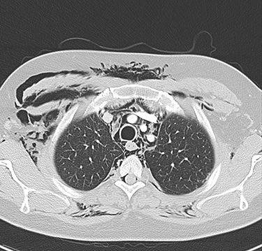 Figure 4 Axial CT of the upper chest with contrast for the second patient, showing pneumomediastinum, along with bilateral subcutaneous emphysema, more predominant on the right side.