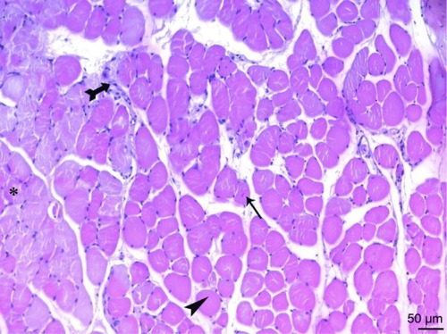 Figure 10 Cross-sections of the fibers in the micrograph of the ischemia reperfusion + picroside II group, show a rounded shape of the cross-sections (arrowhead) and middle position of the core (arrow), mononuclear cell infiltration (tailed arrow) between muscle fibers are observed. In some areas, muscle fiber sections (asterisk) showing a normal, multifaceted cross-sectional surface are observed. H&E ×200.