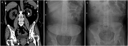Figure 4. Pre-and post-operative CT and abdominal plain film (KUB) of left low calyceal stone treated with microperc: (A) preoperative CT; (B) KUB; (C) stone and fragments disappeared on postoperative day 1.