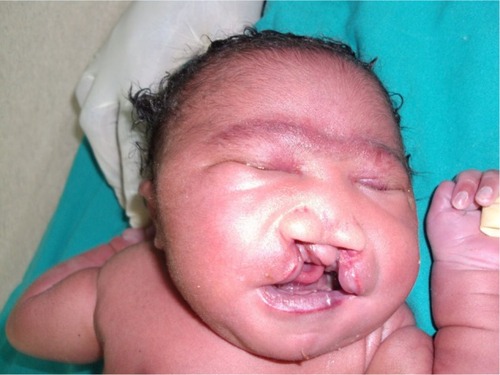 Figure 1 Craniofacial abnormalities observed in our patient.