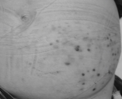 Figure 1 Multiple purple nodules on the overlying skin of the left lower quadrant where graft located.