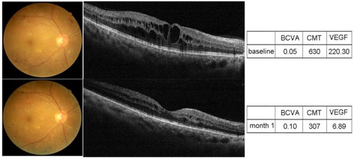 Figure 4 Patient presenting with DME. Intravitreal injections at baseline and 1 month. VEGF levels are given in picograms/millilitre.Abbreviations: BCVA, best-corrected visual acuity (logMAR); CMT, central macular thickness (micrometres).