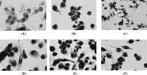 Figure 1 Human monocyte cultures incubated on glass coverslips in the presence of (A) 25 ng/ml M-CSF, (B) 25 ng/ml M-CSF and 30 ng/ml sRANKL, (C) 25 ng/ml M-CSF and 10−9 M LTB4, (D) 25 ng/ml M-CSF and 10−8 M LTB4, (E) 25 ng/ml M-CSF and 10−7 M LTB4, (F) 25 ng/ml M-CSF, 10−7 M LTB4 and 100 ng/ml OPG for 16 days. After TRAP staining and counterstained with hematoxylin, showing that (A) no TRAP-positive multinucleated cell (original magnification ×400) and (B) (C) (D) (E) (F) numerous TRAP-positive mononuclear and multinucleated cells (original magnification ×200 in C group and ×400 in B, D, E, F group).
