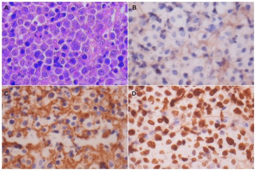 Figure 2 Microphotograph and immunohistochemical staining. Microphotograph showing atypical plasmacytoid tumors cells with abundant amphophilic cytoplasm and a large eccentric vesicular nucleus having a prominent nucleolus (HE × 400) (A). Immunohistochemical staining shows lack of immunoreactivity for CD20 (×400) (B). Strong membranous CD138 immunoreactivity (×400) (C). Strong Ki-67 immunoreactivity in almost all tumors cells (×400) (D).