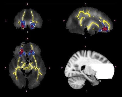 Supplementary Figure 2. Compromised white matter integrity in attention deficit-hyperactivity disorder (ADHD). Regions of significant differences between adolescents with ADHD and controls shown in coronal, axial and sagittal views from the tract-based spatial statistics analysis. The white matter skeleton used in this analysis is displayed in yellow. Regions in which children with ADHD had higher fractional anisotropy (FA) are shown in red. Regions in which children with ADHD had higher axial diffusivity (AD) values than controls are shown in light blue. Group differences were “thickened” for visualization purposes, shown in red and blue for FA and AD respectively (ie, lighter colors represent the actual skeleton and the darker colors are the areas that were “thickened”). The bottom right panel of the figure shows the frontostriatal mask used in the analysis. Reproduced from ref 109: Tamm L, Bamea-Goralv N, Reiss AL. Diffusion tensor imaging reveals white matter abnormalities in Attention-Deficit/Hyperactivity Disorder. Psychiatry Res: Neuroimage. 2012;202:150-154. Copyright © Elsevier 2012