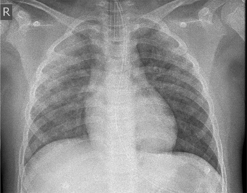 Figure 1 Chest radiograph immediately after intubation from oral to nasal route with bilateral alveolar opacification consistent with pulmonary edema in anaphylaxis.