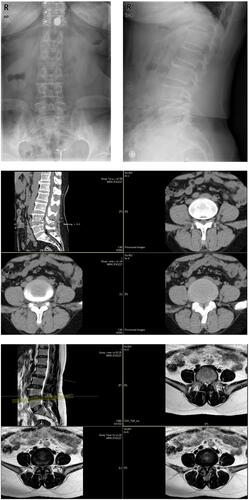 Figure 5 Preoperative X-ray positive and lateral radiographs showed lumbar degeneration. Preoperative CT and MRI showed L4/5 disc herniation and spinal stenosis.
