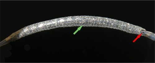 Figure 1 MGuard stent crimped onto a balloon.