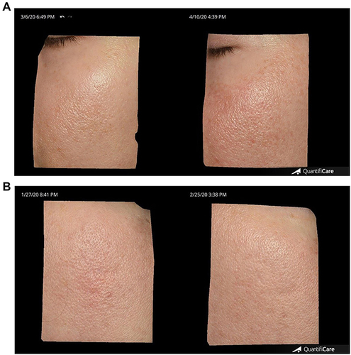 Figure 12 (A and B) 3D Micro Imaging. Example of decreased erythema and inflammation post laser treatment 1 at day 30 between control/bland moisturizer (A) and RSN (B).