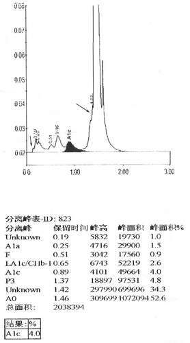 Figure 2(B). HbA1c analysis of her son using D10, arrow indicates the Hb J-Lome1c peak and Hb J-Lome.