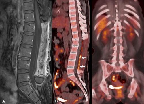 Figure 3 Follow up MRI (A) and PET-CT (B) after chemotherapy showing complete resolution of the hypermetabolic cauda equina lesion. Linear FDG uptake in the posterior lumbar dura (arrows) is postoperative in nature.