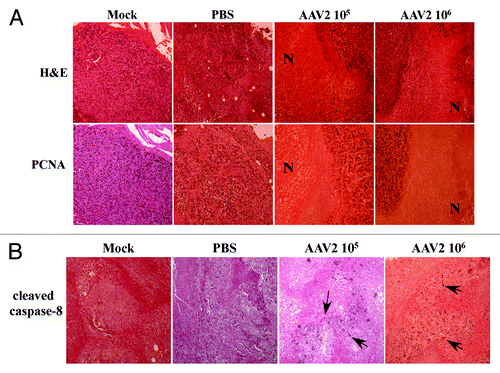 Figure 7. AAV2-induced necrotic death of MDA-MB-435 xenografts correlated with lack of PCNA nuclear staining. (A) Tumor sections were examined with H&E staining and further stained with PCNA antibody. Identical areas in both types of stained tumor sections showed lack of PCNA staining in areas of necrosis induced upon AAV2 infection. AAV2-treated tumors show large areas of necrosis (N). (B) AAV2-induced necrotic death of MDA-MB-435 xenografts correlated with increased staining with antibody against cleaved caspase-8. Tumor sections were examined with H&E staining and further stained with an antibody against cleaved caspase-8. AAV2-infected tumors show increased focal areas of staining which correlates with tumor cell death compared with mock and PBS injected controls.