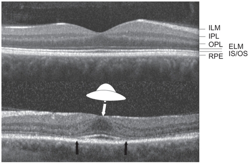 Figure 1 Top: Normal Spectralis spectral domain optical coherence tomography (SD OCT) image with intact photoreceptor inner segment/outer segment junction (IS/OS). Bottom: Spectralis SD OCT from the left eye of patient 10 showing the “flying saucer” sign of hydroxychloroquine retinopathy, an ovoid appearance of the central fovea created by preservation of central foveal outer retinal structures (seen between the black arrows) surrounded by perifoveal loss of the photoreceptor IS/OS junction, and perifoveal outer retinal thinning.