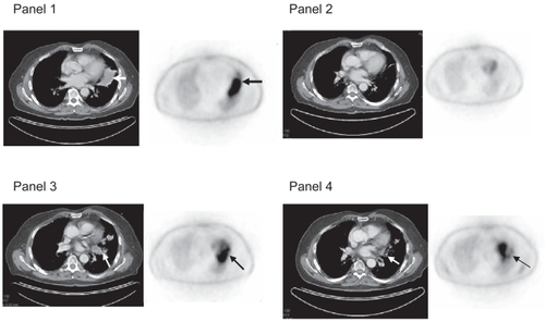 Figure 2 Panel 1 shows large left lung mass on CT scan with corresponding FDG-avidity, biopsy proven follicular lymphoma. Panel 2, 3 months later shows resolution of mass on CT scan and FDG-negative scan. Panel 3, 12 months after 90Y-ibritumomab tiuextan shows infiltrative mass on CT scan and FDG-avid area apart from the heart. Bronchoscopy was negative for recurrent lymphoma and cultures were negative. Panel 4, 24 months after treatment there is residual scarring with decreased FDG-avidity.