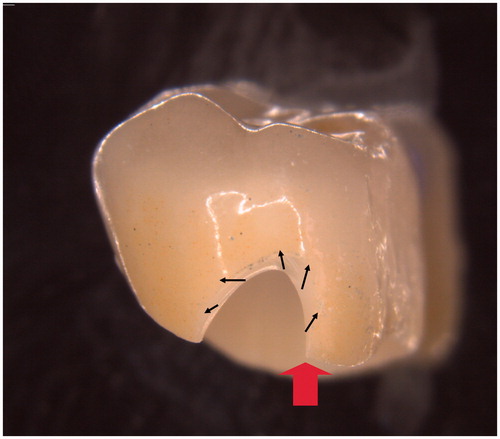 Figure 1. Clinically failed monolithic zirconia crown. The crown fractured immediately during clinical use. There was no discrepancy between tooth and model. The fracture origin (large arrow) is in the crown margin and the direction for the crack propagation is marked with small arrows.