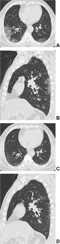 Figure 2 (A–D) Male, older patient with COVID-19. The initial CT at the hospital (A and B). The axial initial CT (A) shows the patchy ground-glass opacities (GGOs), crazy-paving pattern, and a few of consolidation under the subpleural area of the both lower lobes. The sagittal initial CT (B) shows the patchy GGOs under the subpleural area of the right upper lobe and the right lower lobe. The follow-up CT obtained after 451 days (C and D). The axial follow-up CT (C) and the sagittal follow-up CT (D) show reticular parterns, irregular linear opacities and a few of GGOs remain under the subpleural area of the both lower lobes (C) and the right lower lobe (D).