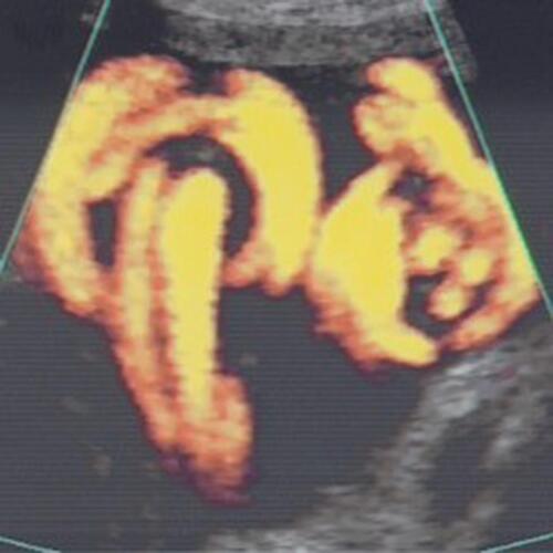 Figure 7 Power Doppler image depicting two adjacent, but separate true knots of the umbilical cord (note two “smiley faces”).Note: Reproduced with permission from Sherer DM, Dalloul M, Zigalo A, Bitton C, Dabiri L, Abulafia O. Power doppler and 3-dimensional sonographic diagnosis of multiple separate true knots of the umbilical cord. J Ultrasound Med. 2005;24:1321–1323. © 2016 by the American Institute of Ultrasound in Medicine.Citation67
