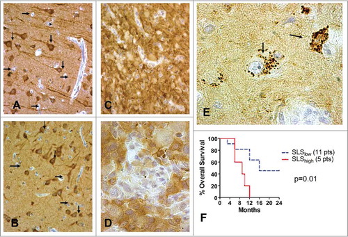 Figure 1. Immunohistochemical expression of LC3A and LC3B in the normal brain and in glioblastomas. Strong cytoplasmic LC3A and LC3B expression was apparent in all neurons and their processes, but not in glial cells ((A), (B)). Strong cytoplasmic LC3A and LC3B expression in glioblastoma cells ((C) and (D), respectively). (E) shows a typical LC3A+ staining of multiple intracytoplasmic SLSs, in glioblastoma cells. (F) shows the Kaplan-Meier survival curves of patients with glioblastoma stratified for SLS expression.