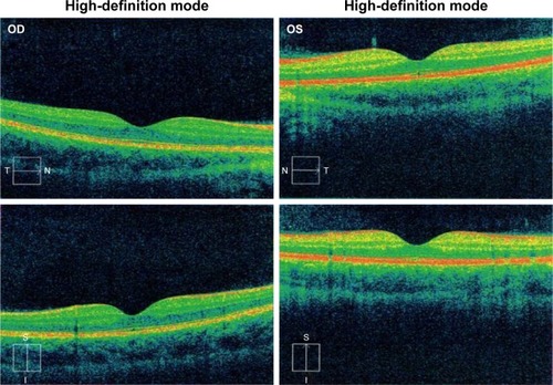 Figure 2 Time-domain optical coherence tomography (Cirrus™, Carl Zeiss Meditec) findings from Case 1.