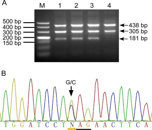 Figure 1. Identification of the Hb Rush mutation using tetra-primer ARMS. A: Representative agarose gel electrophoresis pattern of tetra-primer ARMS for detecting the Hb Rush G > C mutation. M: DNA ladder; Lanes 1–3, heterozygote of Hb Rush mutation, which produces a 181 bp fragment specific for the mutant allele C, a 305-bp fragment for wild-type allele G, and a 438-bp fragment for internal control. Lane 4, normal control. B: Sanger DNA sequencing confirmed the Hb Rush G/C heterozygous state.