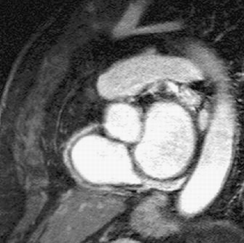 Figure 2. TFE: Proximal right coronary artery stenosis.