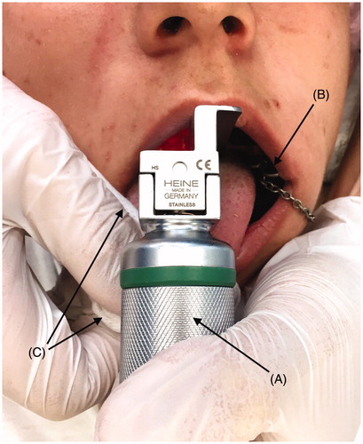 Figure 1. Usage of the ROMV technique during laryngoscopy. Note the wide opening of the mouth and the readily accessible area towards the posterior plate and the pharynx. A: Laryngoscope with size 3 Macintosh blade. B: Bite block applied to the left side of the mouth to maintain wide opening of the mouth, hence not requiring manipulation of the lower jaw. C: Gauze is used to grasp the tip of the tongue with the right hand and gently to pull it outwards.