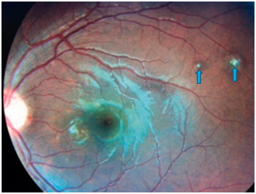 FIGURE 4. Left eye fundus photo revealing the multifocal choroiditis healing and scarring (arrows pointing to the lesions) post intravenous antifungal completion.