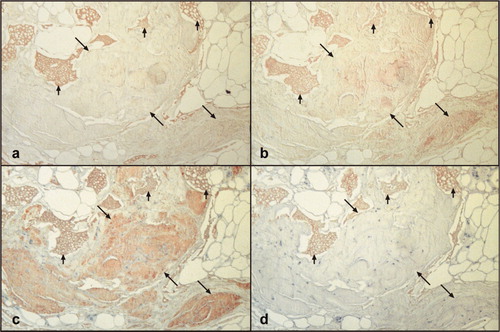 Figure 2.  Immunohistochemical identification of the amyloid of patient UNK using different antibodies. (a), anti-κBJP (mix); (b), anti-ALκ (SIN); (c), anti-ALκ (KRA); (d), anti-ALλ (HEN). Amyloid deposits are shown by the diagonal arrows; blood is indicated by the vertical arrows.