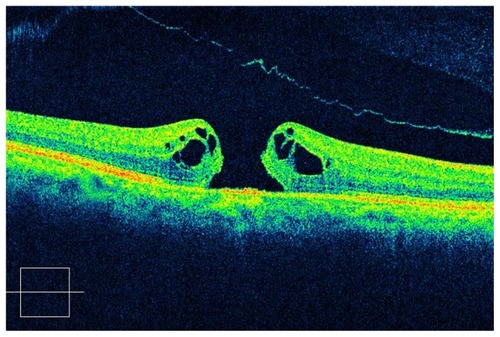 Figure 3 Preoperative OCT of traumatic macular hole with C3F8 gas.