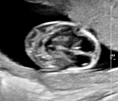Figure 2 First-trimester septated cystic hygroma in a 29 year-old, P2 at 11 and 3/7 weeks’ gestation. Non-invasive prenatal screening was low risk for fetal aneuploidy, yet maternal Noonan’s syndrome was suspected and later confirmed by conventional testing. Fetal Noonan’s syndrome was confirmed at amniocentesis. The patient elected to continue her pregnancy and delivered at 39 weeks’ gestation. The male neonate exhibited facial dysmorphic features consistent with established Noonan’s syndrome (see original report, Sherer DM, Hsieh V, Kheyman M, Makanjuola O, Dalloul M. Cell-free DNA screening following first-trimester septated cystic hygroma leading to diagnosis of previously unknown familial Noonan Syndrome. Eur J Obstet Gynecol Reprod Biol. 2021 Sep;264:389. doi: 10.1016/j.ejogrb. 2021.07.0566).Citation100