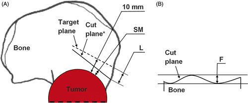Figure 4. Parameters for the geometrical and surgical evaluation of each cut plane of a tumor cutting. (A) Location (L) (mm) and surgical margin (SM) (mm); the target plane is the dashed line; the cut plane is the solid line. *The cut plane is represented here by a line instead of a curve for better clarity in the definition of L and SM. See main text for details. (B) Flatness (F) (mm); the cut plane is the solid curve.