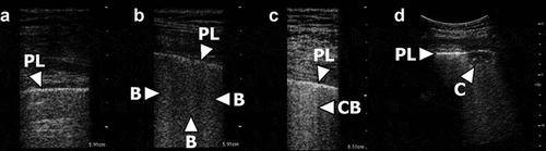 Figure 1. TUS findings and corresponding score. a) The pleural line (PL) appears normal. No B-lines or consolidations are present corresponding to a score of 1. b) Multiple B-lines (B) originating from the pleural line. The B-lines involve less than 50% of the pleural line, corresponding to a score of 2. c) Multiple confluent B-lines (CB) are present. More than 50% of the pleural line is involved corresponding to a score of 3. d) A small subpleural consolidation (C) is present just below the pleural line, corresponding to a score of 4. Image courtesy of Falster et al. [Citation11].
