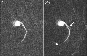 Figure 2. The LAD of a swine following dilute contrast agent injection acquired using a) FLASH and b) TrueFISP. Distal portions of the artery and the branch near the root (arrows) are better depicted in b) due to the better CNR obtained using the TrueFISP acquisition scheme.