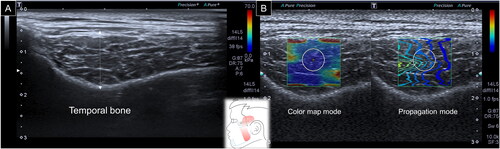 Figure 2. Ultrasound imaging for thickness (A) and stiffness (B) measurements of the temporalis muscle. White dashed line, maximal muscle thickness.