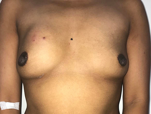 Figure 1 Tender mass of the right breast with mild nipple retraction.