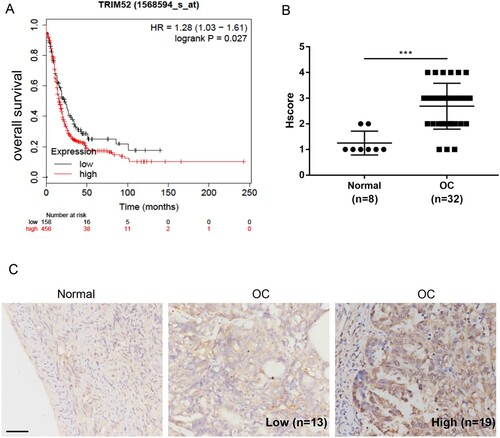 Figure 1. High level of TRIM52 expression predicts poor prognosis. (A) KM-plot database was used for multivariate analysis of the survival of patients with OC. (B) Hscore of tissues. (C) The expression level of TRIM52 was measured in normal and OC tissues by IHC staining. (100 µm scale bar).