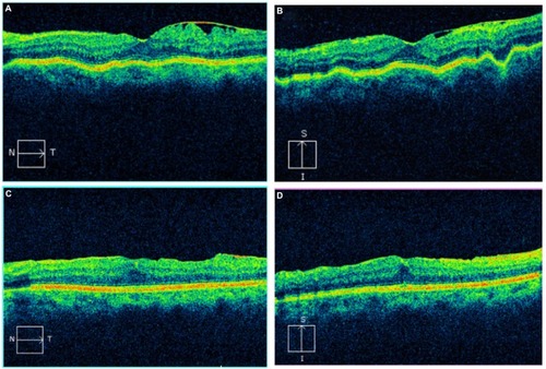Figure 3 The horizontal line scan from the SD-OCT of the left eye of the patient demonstrates subtle chorioretinal folds (A). The vertical line scan more clearly demonstrates the chorioretinal folds (B). On both the horizontal and vertical line scans taken after treatment, there is a resolution of the folds (C and D).