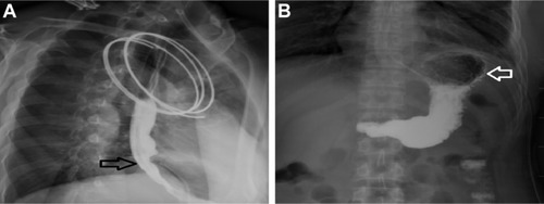 Figure 5 (A) A control esophagogram showed that the esophagus (black arrow) had neither stenosis nor leakage. (B) The shape and function of the stomach (white arrow) were normal.
