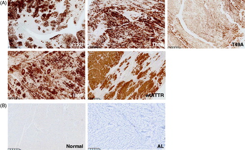 Figure 6. 14G8 immunolabels cardiac tissue from patients with hereditary and sporadic ATTR amyloidosis cardiomyopathy. (A) 14G8 strongly immunolabeled TTR deposits in diseased ATTR amyloidosis heart tissue derived from patients with familial (V122I, T60A, T49A, I84S) and wild-type forms of cardiac ATTR amyloidosis. (B) No 14G8 immunolabeling was observed in cardiac tissue from healthy individuals (Normal) or from cardiomyopathy patients with non-related AL amyloidosis (AL). Scale bar = 500 μm.