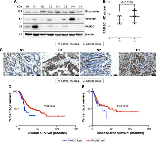 Figure 1 FAM3C was overexpressed in gastric cancer tissue, and high FAM3C expression was related to poor overall survival.