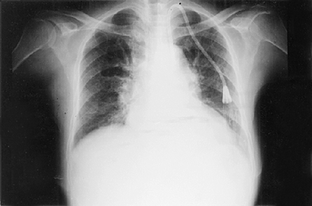 Figure 1. Chest X-ray with the catheter located on the left of the cardiac shadow.